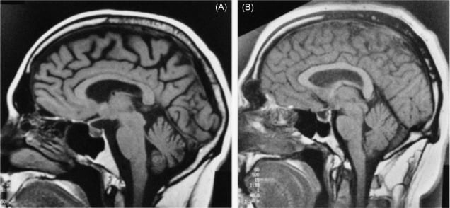 cognitive decline