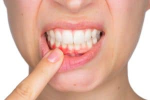 Gum Disease alzheimer's