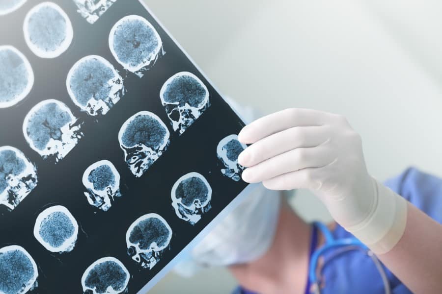 Stem Cells for Cerebral Artery Ischemic Stroke